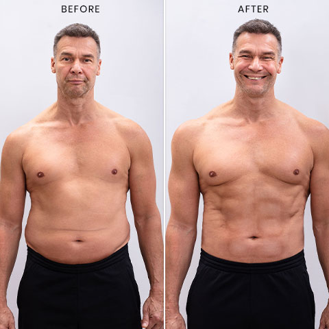 Coolsculpting for Men