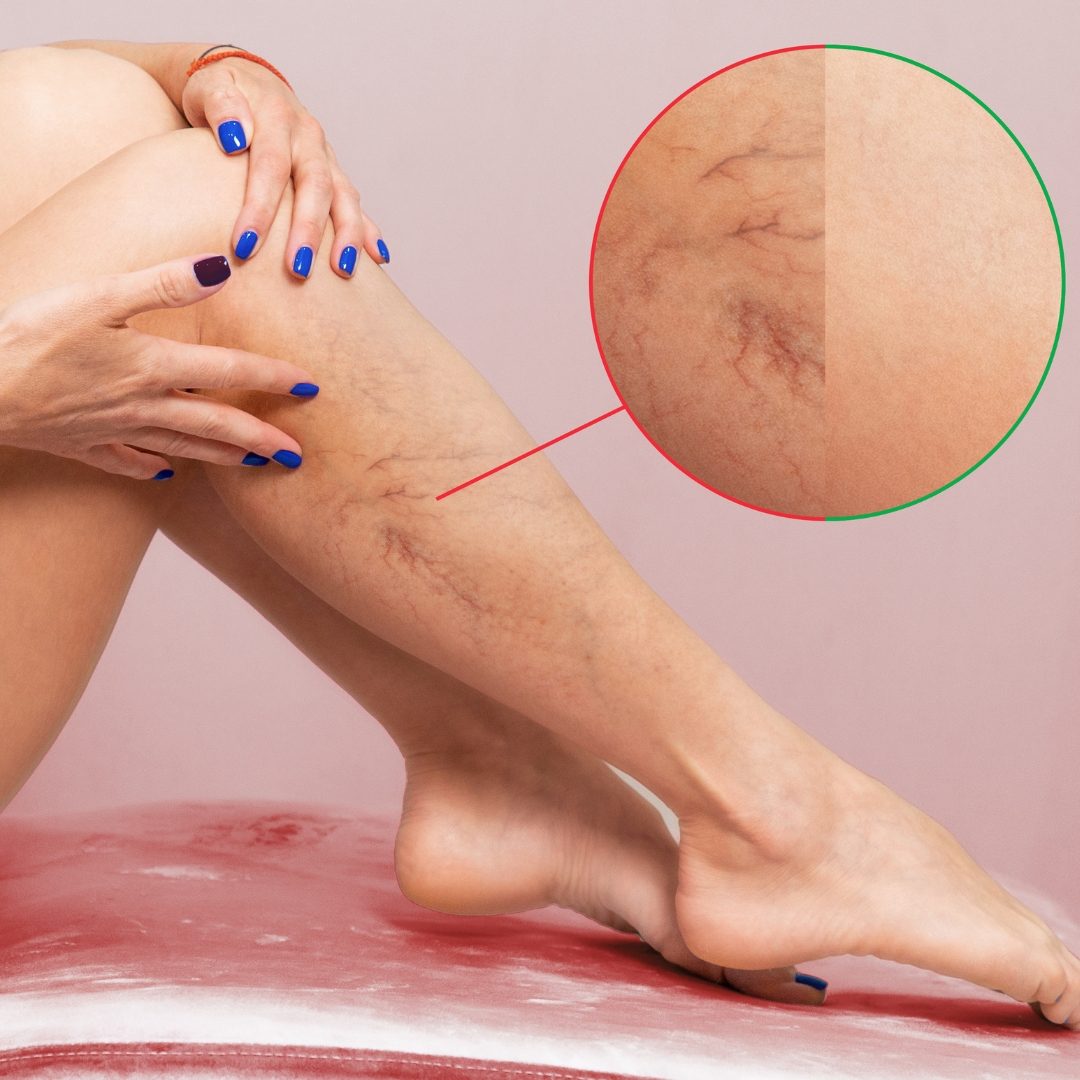 Broken Capillaries / Spider Vein Treatment in St. Paul & Roseville, MN