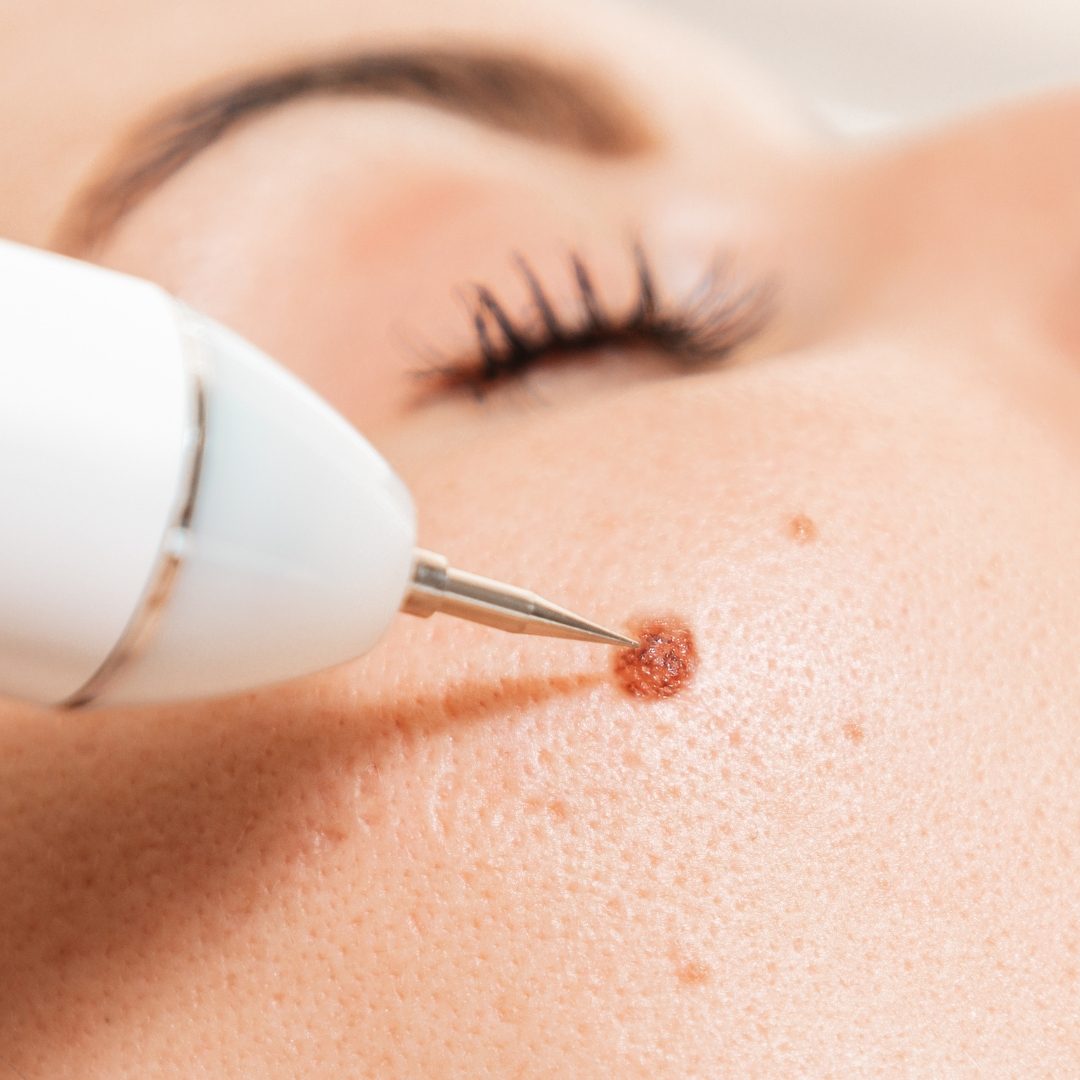 Brown Spot Laser Removal in St. Paul & Roseville, MN