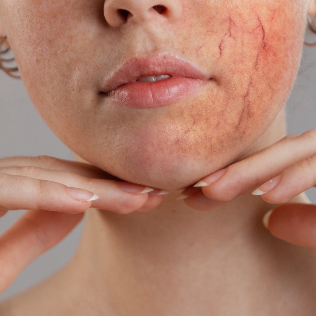 Facial Blood Vessel Treatment in St. Paul & Roseville, MN