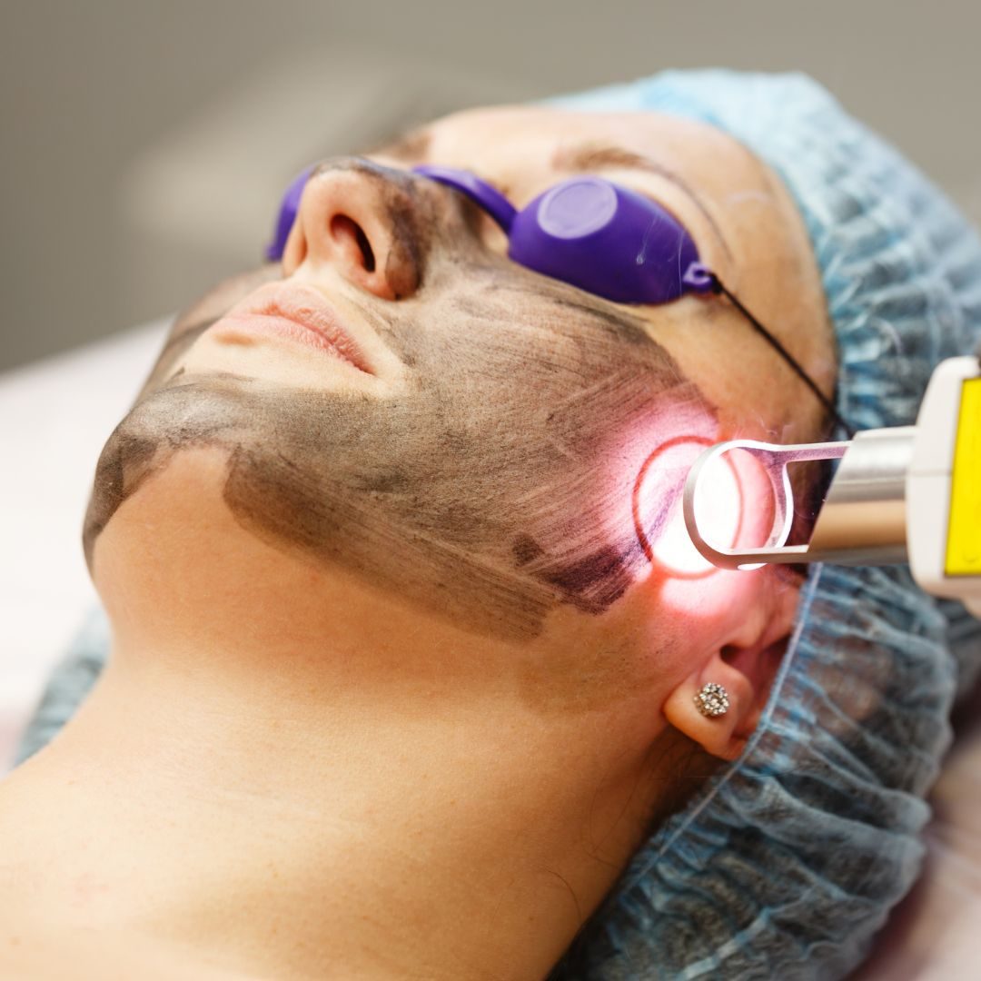 Facial Laser Treatment in St. Paul & Roseville, MN