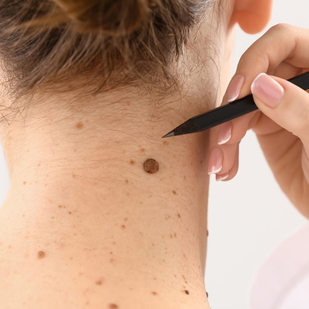 Freckle Laser Removal in St. Paul & Roseville, MN