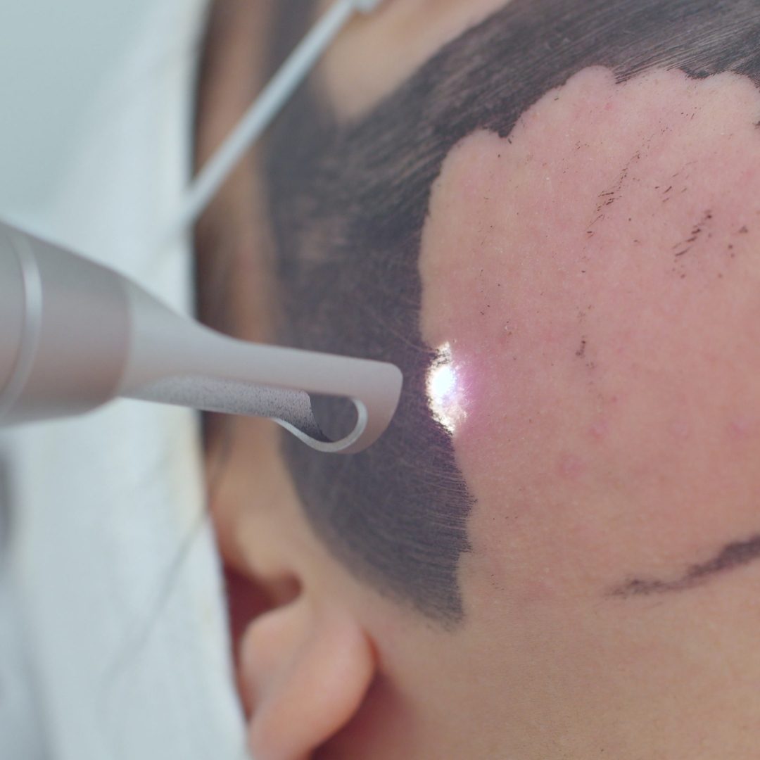 Laser Pore Treatments Christina Clinic