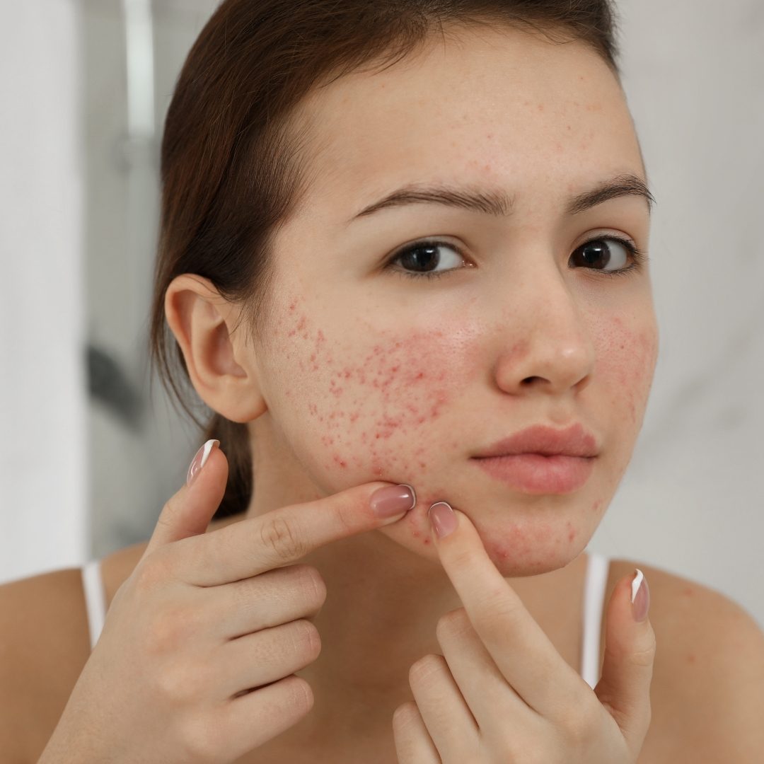 Severe Acne Treatment in St. Paul & Roseville, MN