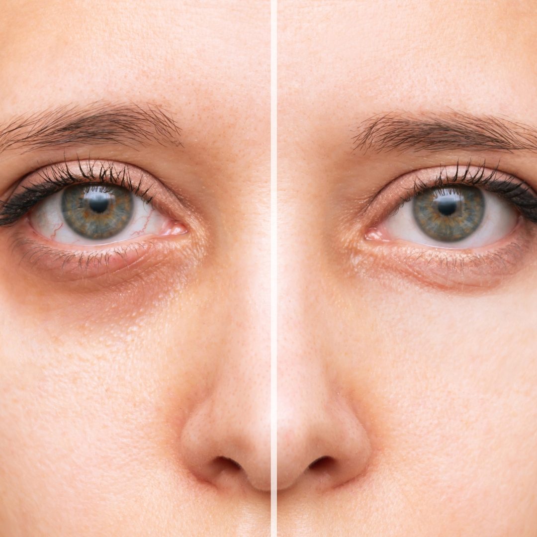 Under Eye Wrinkle Laser Treatments Christina Clinic