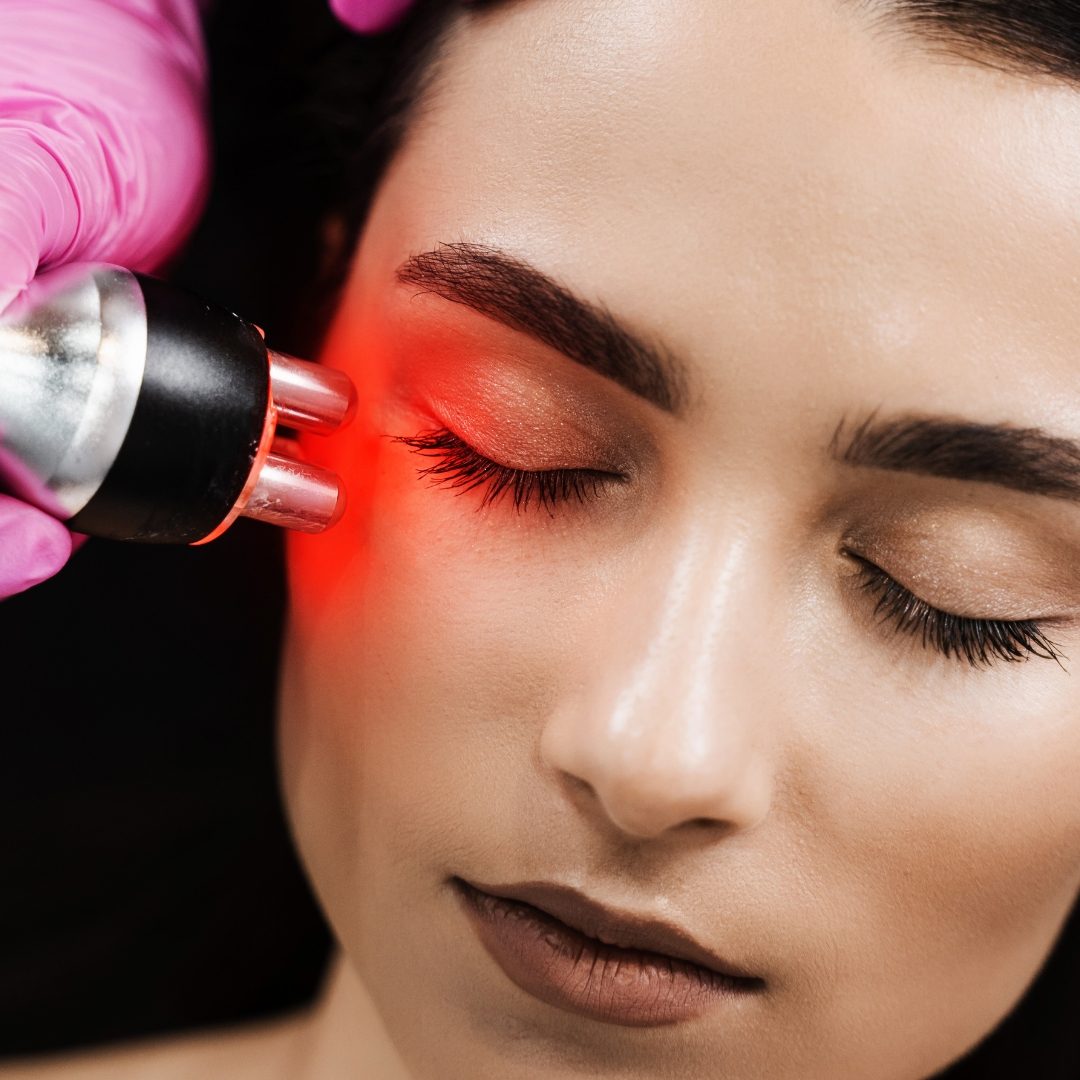 Under Eye Wrinkle Laser Treatment in St. Paul & Roseville, MN